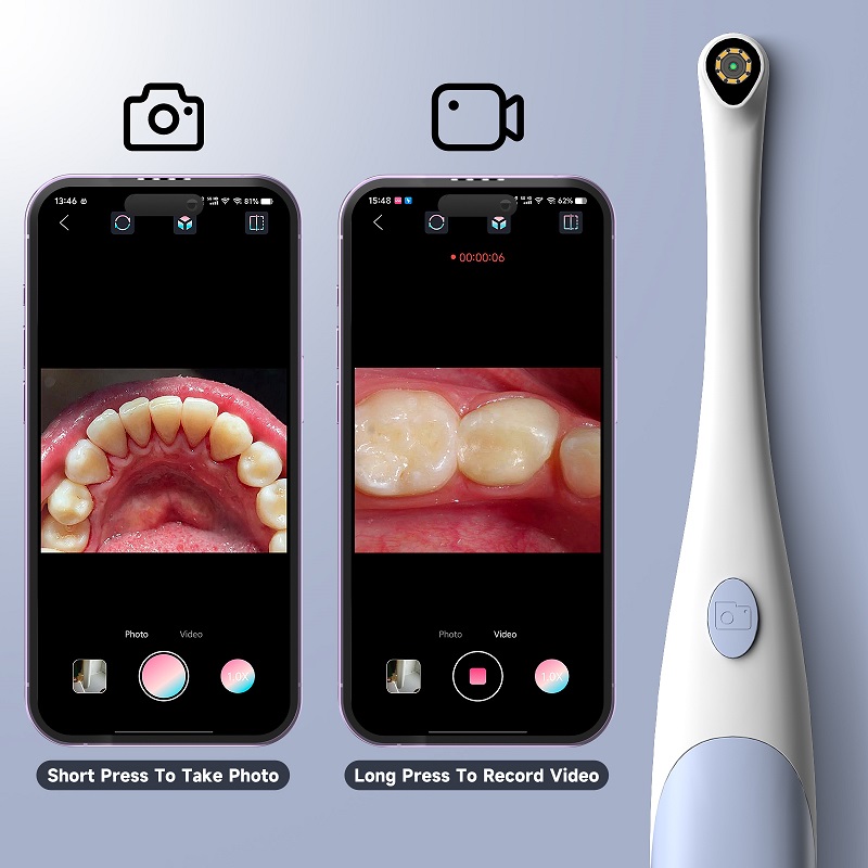 Oral Endoscope Camera 1440P Ph - огляд і ціна Teeth Whitening Video