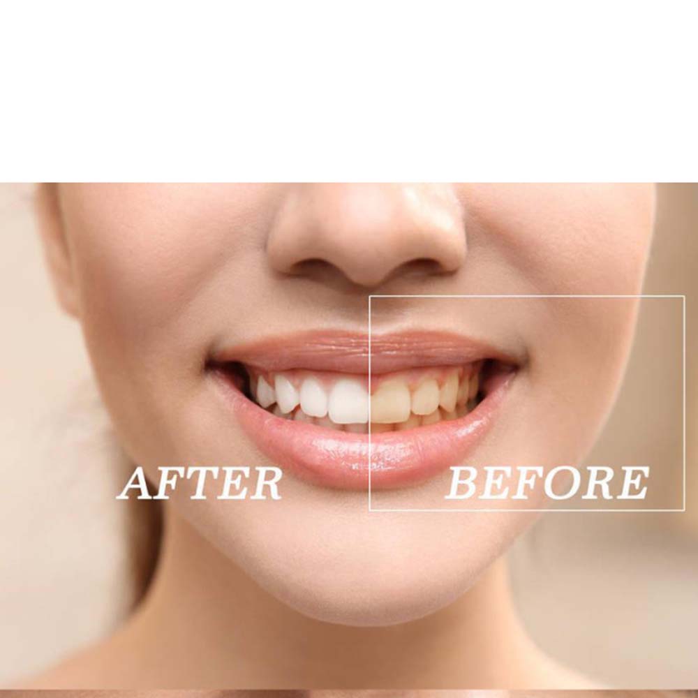 Top Quality Peroxide Teeth Whi - огляд і ціна Teeth Whitening/Bleaching